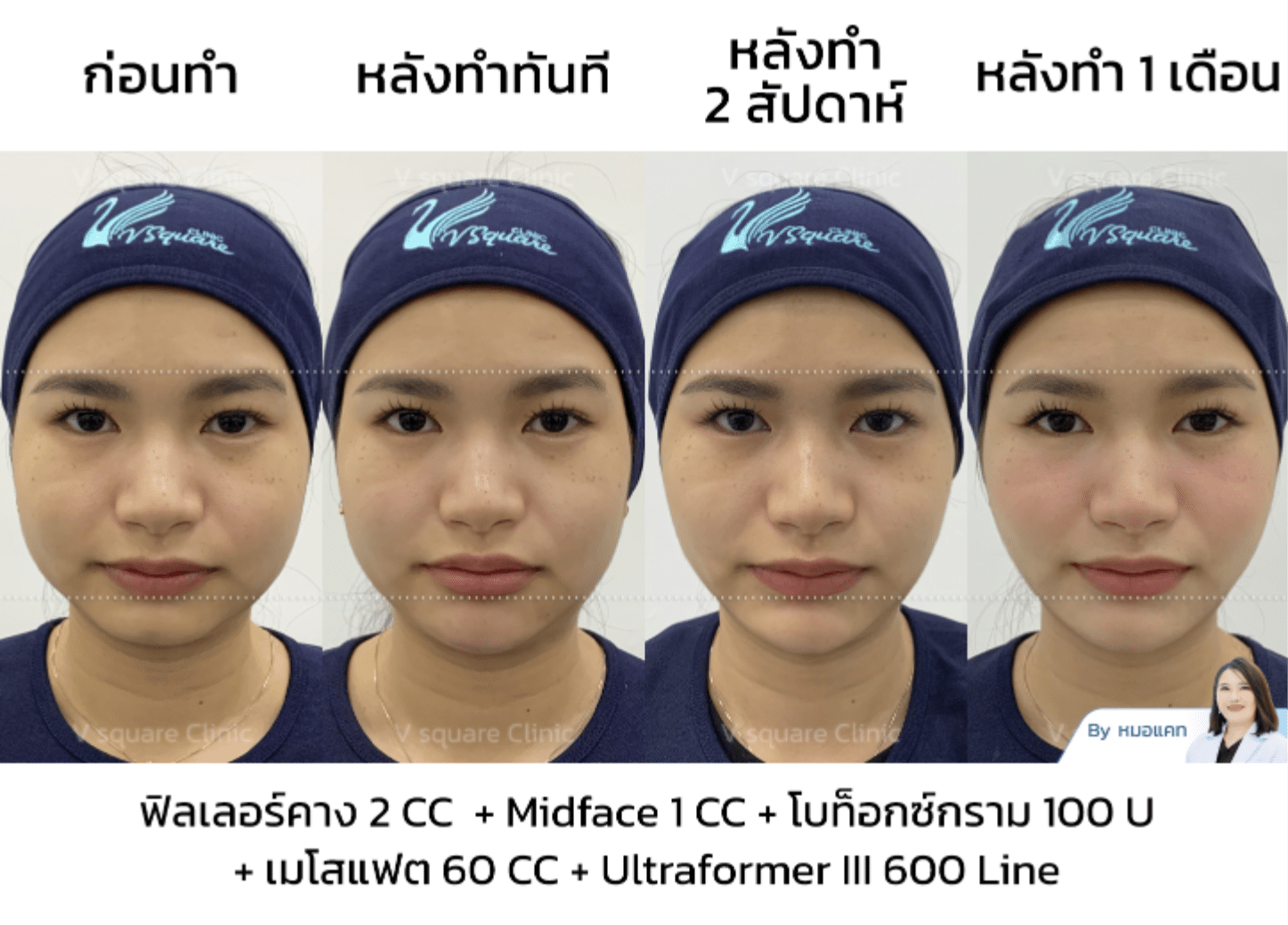 jawline contouring botox_คุณเนย โดย หมอ แคท