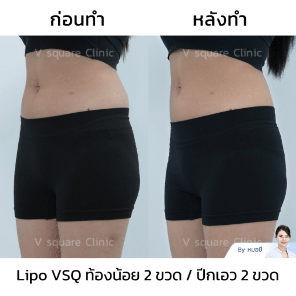 meso fat stomach_คุณปาร์ม