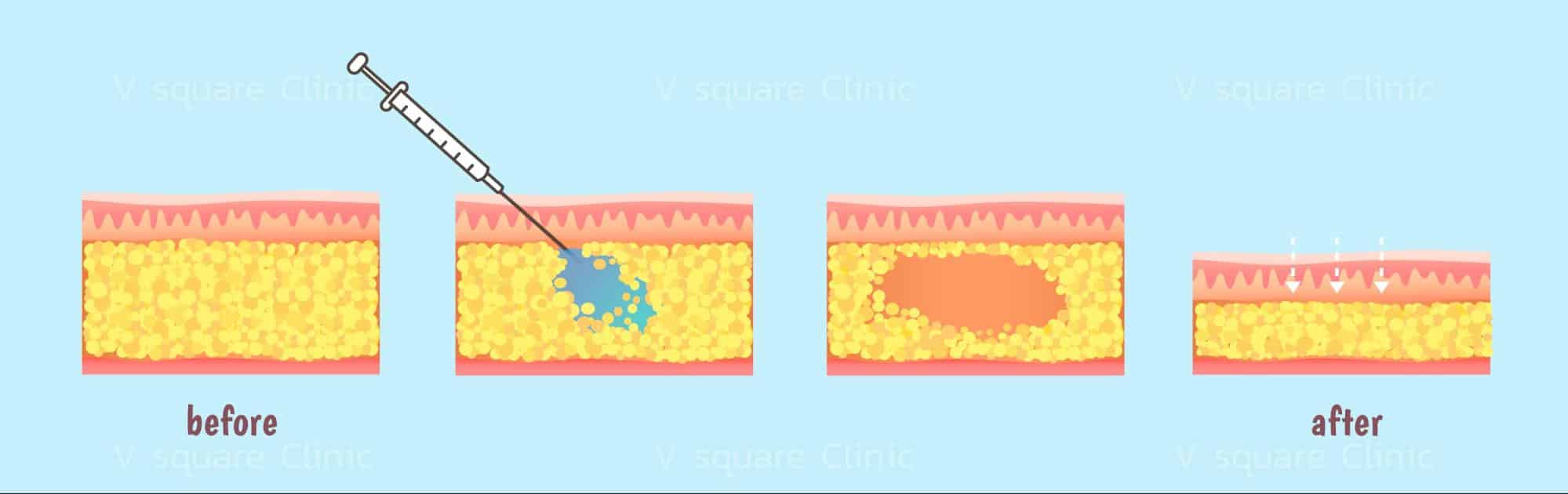 mesofat how it works