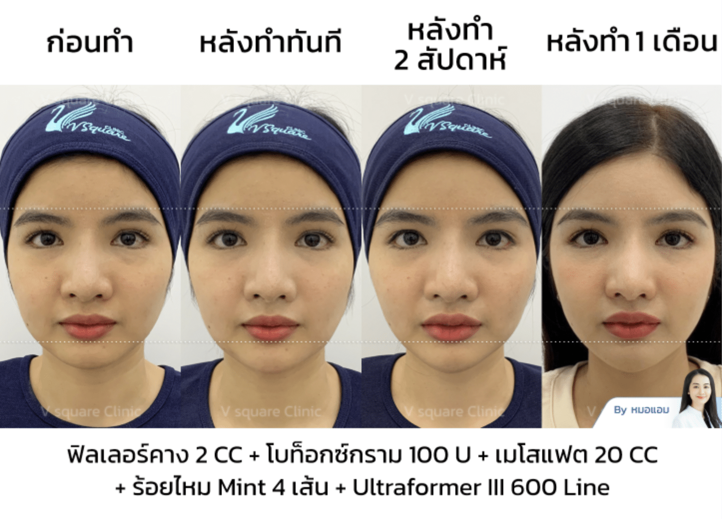 mesofat review_คุณซานตี้ โดย หมอ แอม