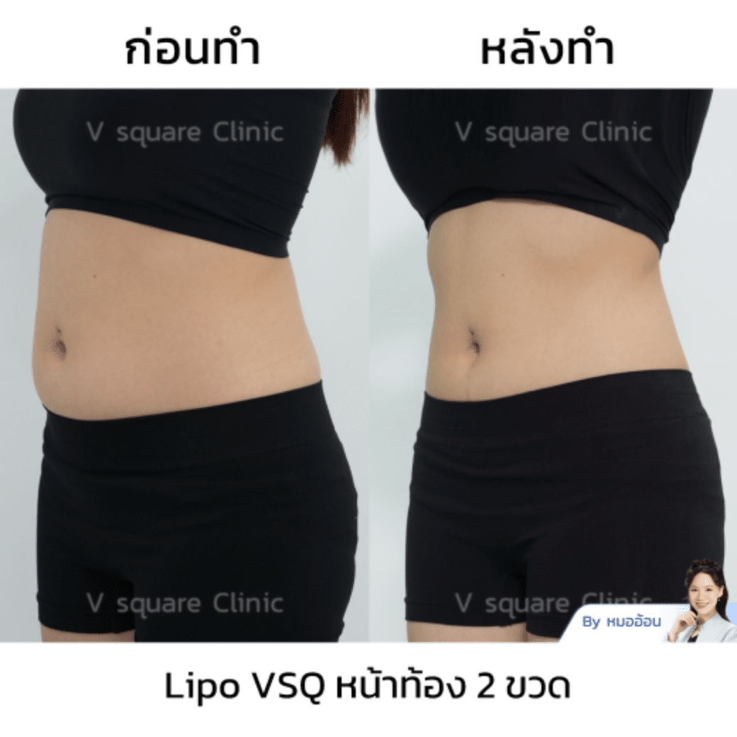 mesofat stomach review_คุณแคท