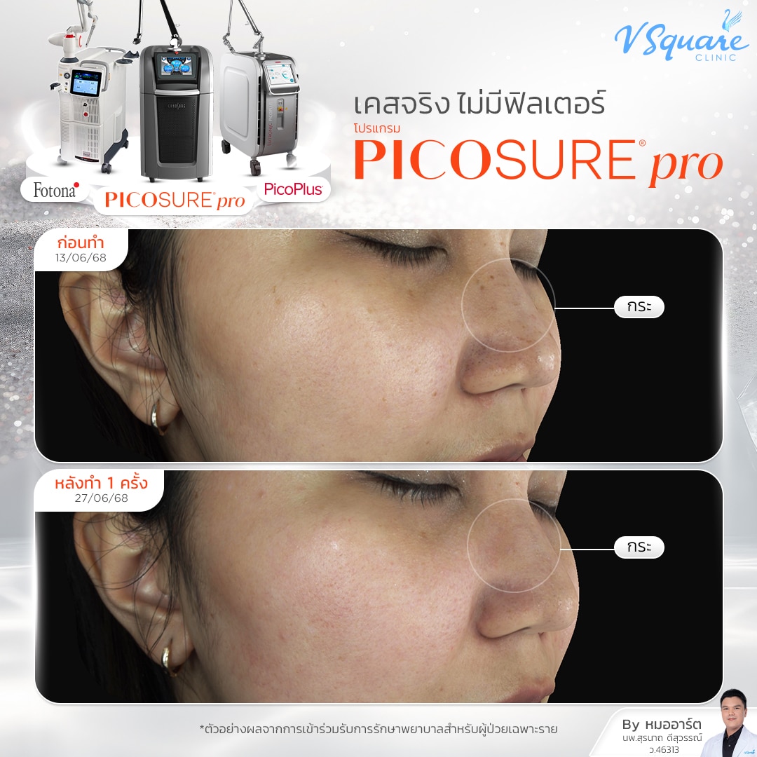 Review Pico_คุณเป็ก By Dr.Suranart Deesuwan