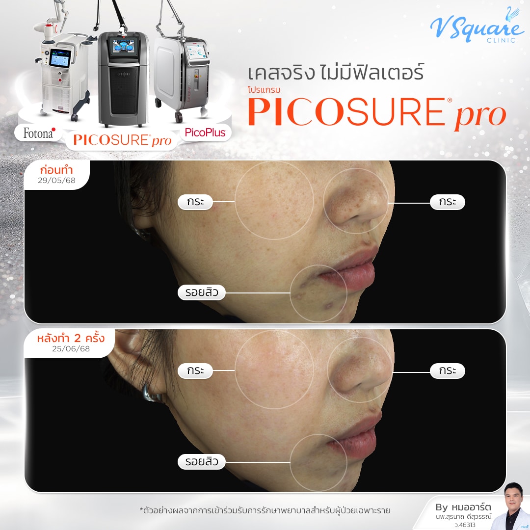 review Pico_คุณนัน By Dr.Suranart Deesuwan